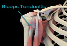 Proximal Biceps Tendinitis