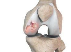 Chondral or Articular Cartilage Defects