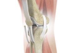 ACL Reconstruction of Patellar Tendon