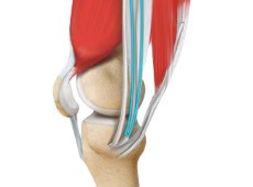 ACL Reconstruction Procedure of Hamstring Tendon