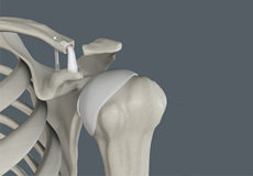 Acromioclavicular Joint (AC) Joint Reconstruction