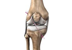 Failed Anterior Cruciate Ligament (ACL) Reconstruction