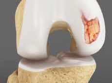 Articular Cartilage Injury