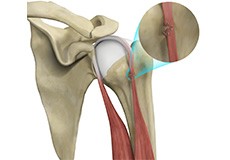 Bicep Tendon Rupture