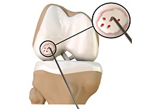 Chondroplasty