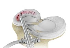 Failed Meniscus Repair