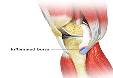 Goosefoot Bursitis of the Knee