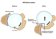 Hill-Sachs Lesion