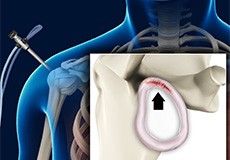  Labral Repair