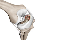 Meniscal Injuries