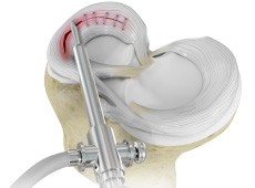 Meniscus Repair