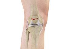 Fractures of the Patella