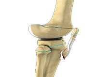 Pediatric Tibial Tubercle Fractures