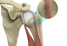 Proximal Biceps Tendon Rupture