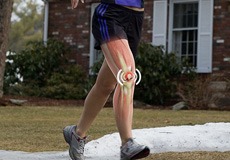 Runner's Knee