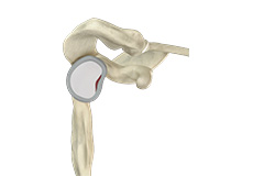 Shoulder Labral Tear