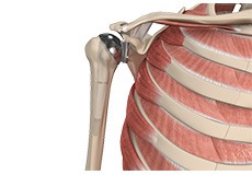 Am I a Candidate for Shoulder Replacement?