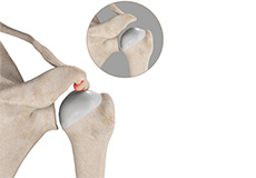 Subacromial Decompression