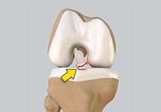 Tibial Eminence Spine Avulsion Fracture